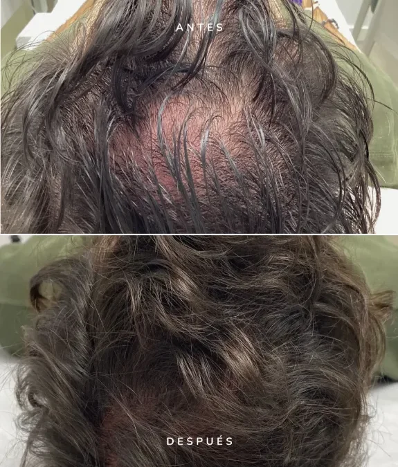 Mesoterapia capilar: una solución precisa y avanzada contra la caída del cabello